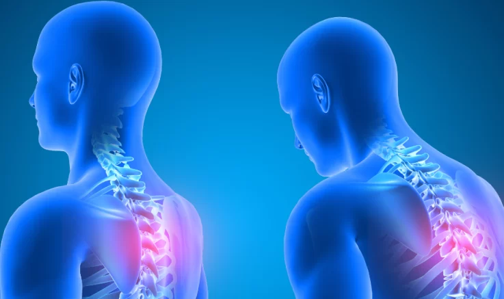 La importancia de la postura para mantener la salud y de qué forma puede corregirse: